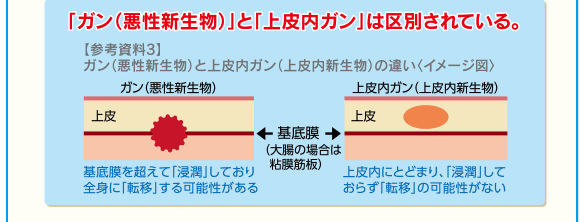 「ガン(悪性新生物)」と「上皮内ガン」は区別されている。【参考資料3】ガン(悪性新生物)と上皮内ガン(上皮内新生物)の違い〈イメージ図〉