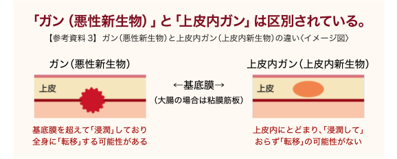「ガン(悪性新生物)」と「上皮内ガン」は区別されている。【参考資料3】ガン(悪性新生物)と上皮内ガン(上皮内新生物)の違い〈イメージ図〉